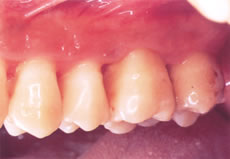 (1) 歯周病によって骨が吸収して、歯周ポケットが正常値よりも5mm深くなった状態