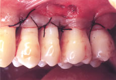 (3) 歯ぐきを骨の高さに合わせて縫合する