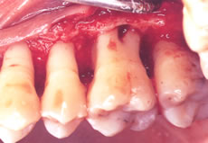 (2) 歯ぐきを剥がして歯周ポケット内の歯石、感染骨を除去し歯根を磨き、再生療法をほどこす