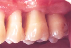 (4) 抜糸しプラッシングをする事によって健康な歯 ぐきがよみがえる