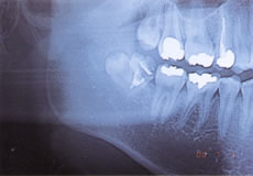 埋伏歯のレントゲン写真