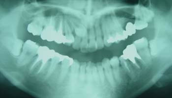 埋伏歯を含む成人外科矯正
