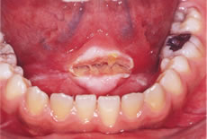 (5) 舌下部潰瘍