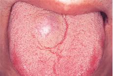(2) 舌の血管腫
