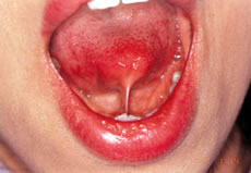 (1) 舌小帯強直症