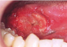 (3) 舌癌
