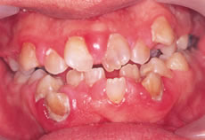 (5) 歯肉増殖症