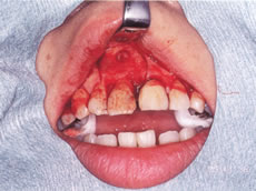 (1) 右上前歯の根の先端に、膿みの袋ができている