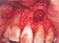(3) 根の先端と病巣を奇麗に掻爬し、歯ぐきをもとの位置に縫い合わせる。