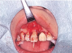 (2) 歯ぐきをめくり上げ、歯の根に薬を詰めて根の先端を切断する
