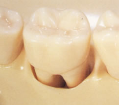 歯周病によって骨が吸収し歯根が露出している状態