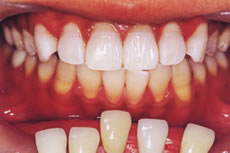 (3) 歯のホワイトニング終了