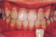 (2) 歯のホワイトニング開始