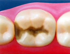 (1)術前の虫歯