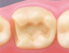 (2)虫歯部分を削合し下のインレーを施す