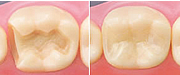 虫歯を削り（左）インレーで塞ぐ（右）。ハイブリットセラミックインレーではほとんど自分の歯と見分けがつかない修復が可能。
