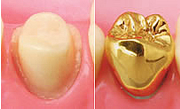 虫歯を削り（左）インレーで塞ぐ（右）