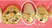 歯の欠損部に入る人工歯のダミー