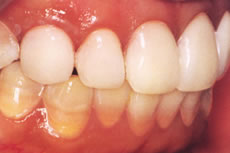 (3) 歯のホワイトニング終了