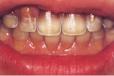 (2) 歯のホワイトニング開始